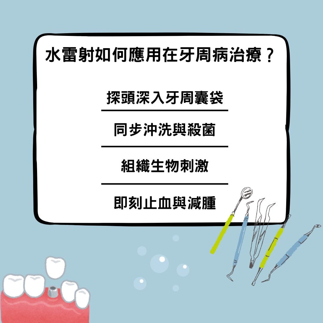 水雷射如何應用在牙周病治療？